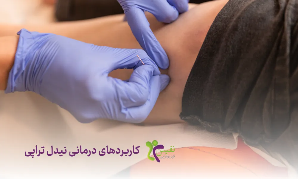 کاربردهای درمانی نیدل تراپی - سوزن خشک چیست
